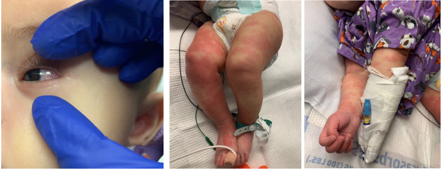 Conjuntivitis y erupción en brazos y piernas en la bebé del caso reportado en Estados Unidos Las imágenes son compartidas con autorización de los médicos que reportaron el caso y los padres de la paciente
